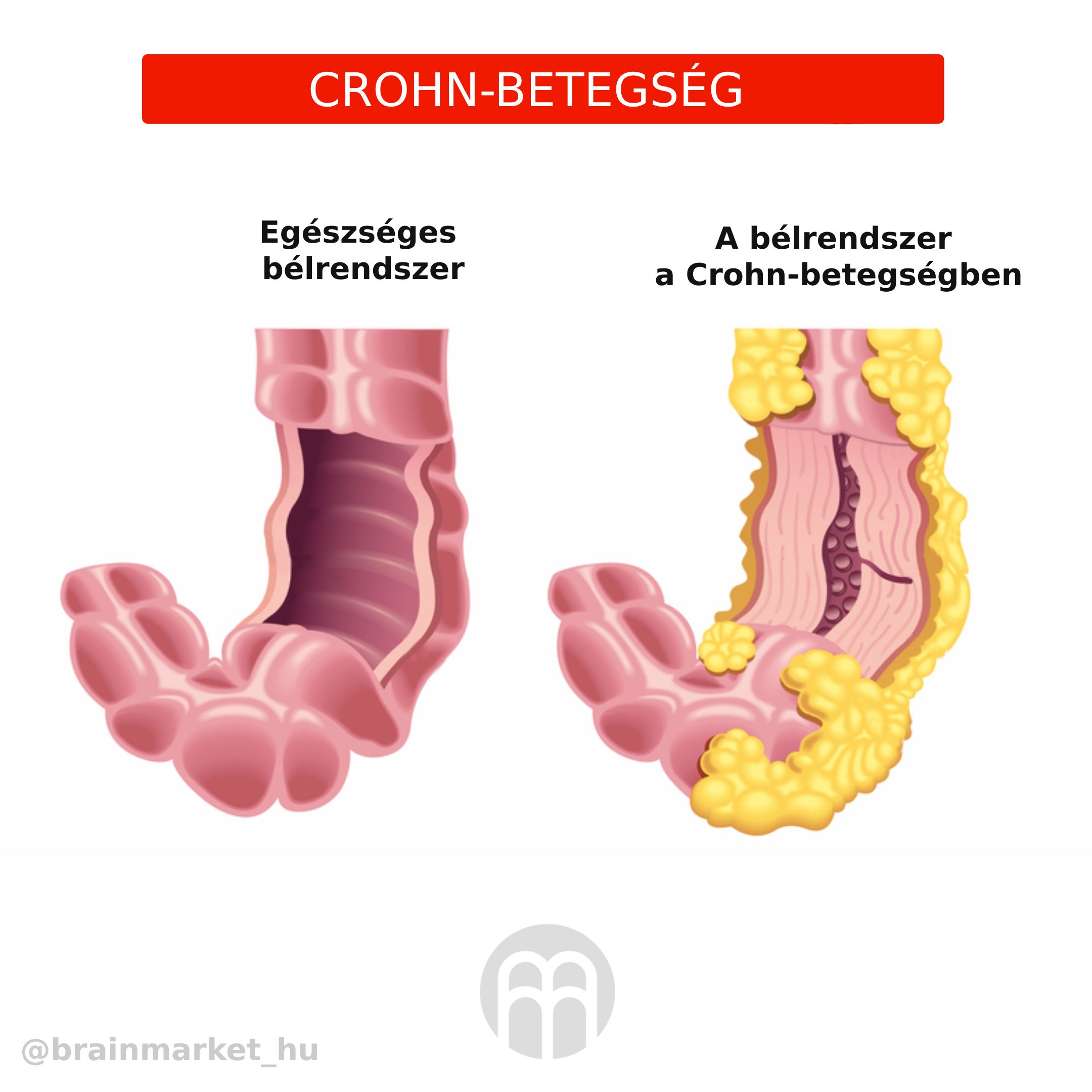 Crohnova nemoc_infografikaHU